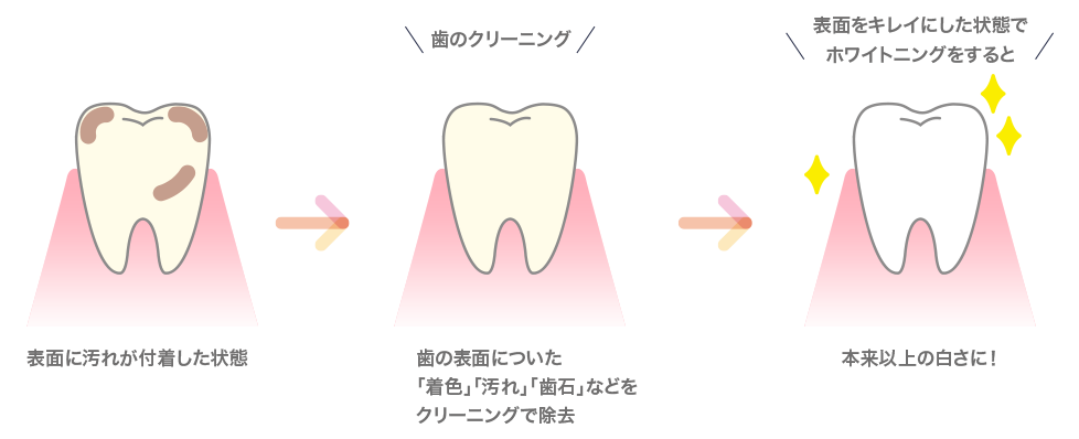 ホワイトニングイメージ